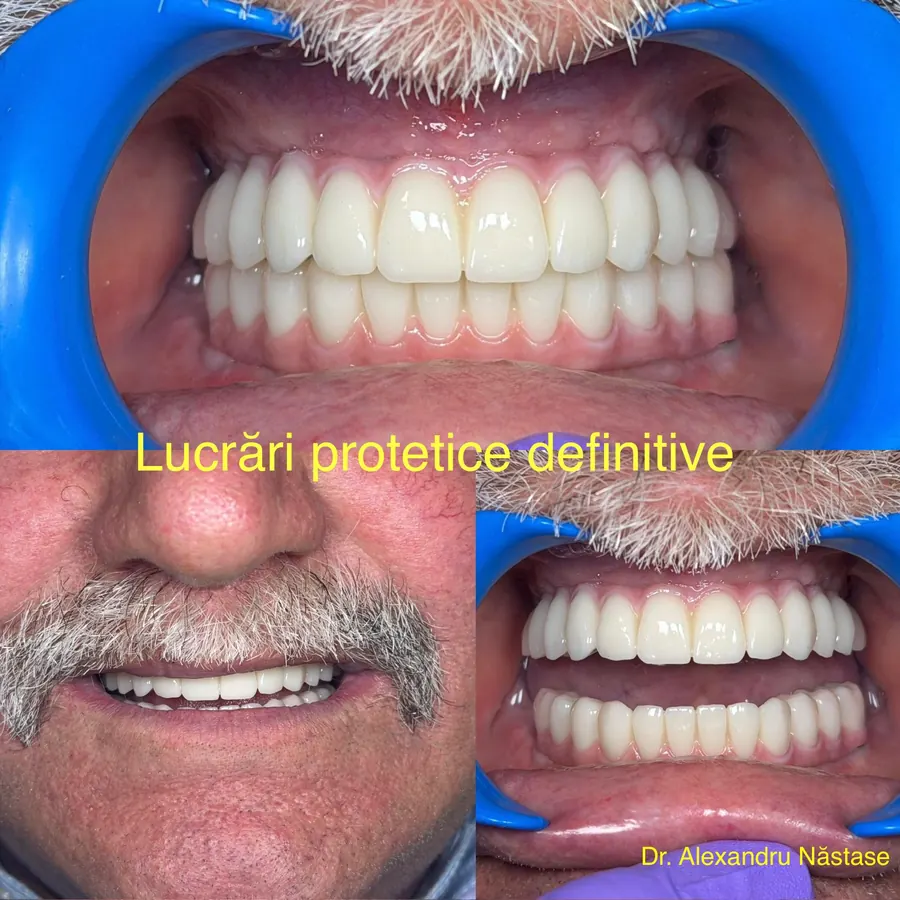 All-on-6, lucrare definitivă