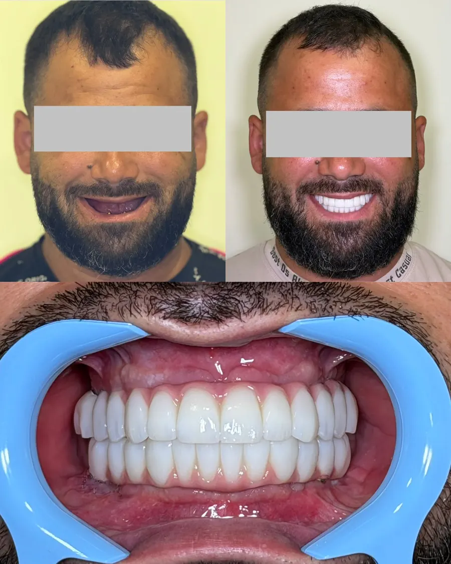Reabilitare cu implanturi All-on-X