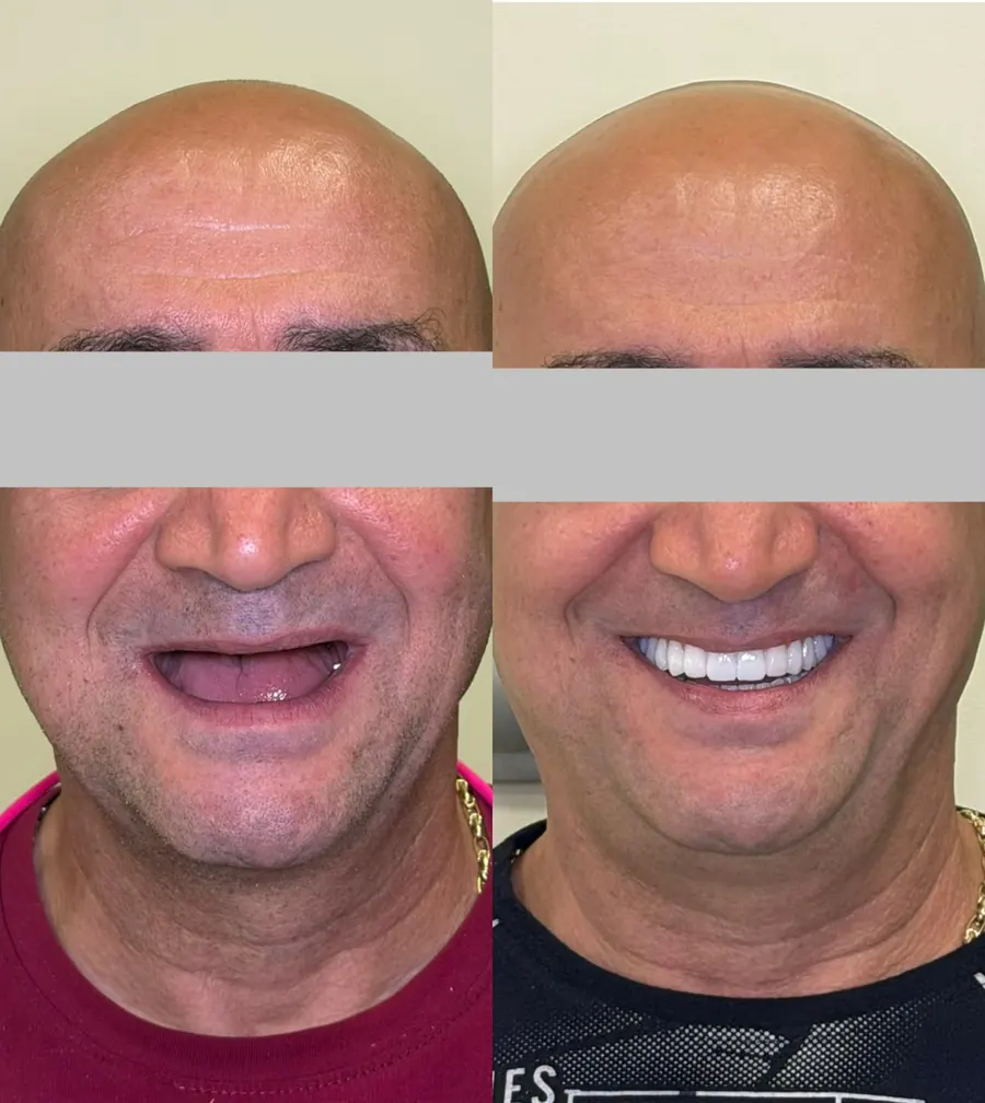 Reabilitare orală completă