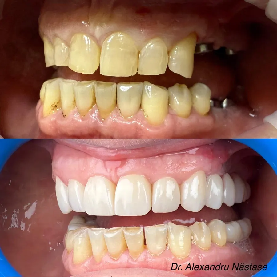 Reabilitare cu fațete și implanturi dentare