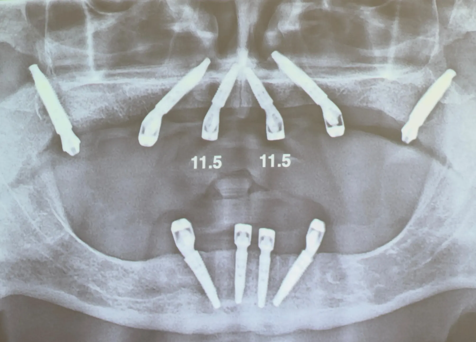 Radiografie panoramică: 6 implanturi la maxilar și 4 la mandibulă, cele din spate înclinate